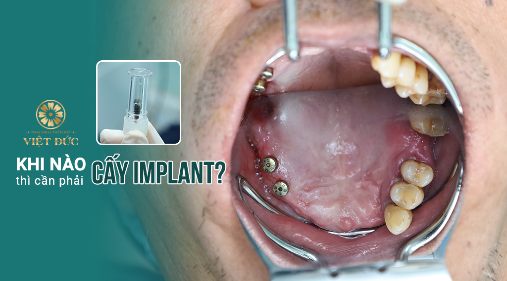 Khi nào nên cấy implant