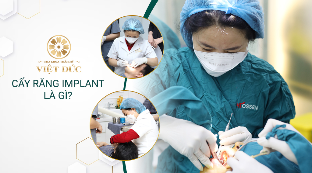 Cấy implant