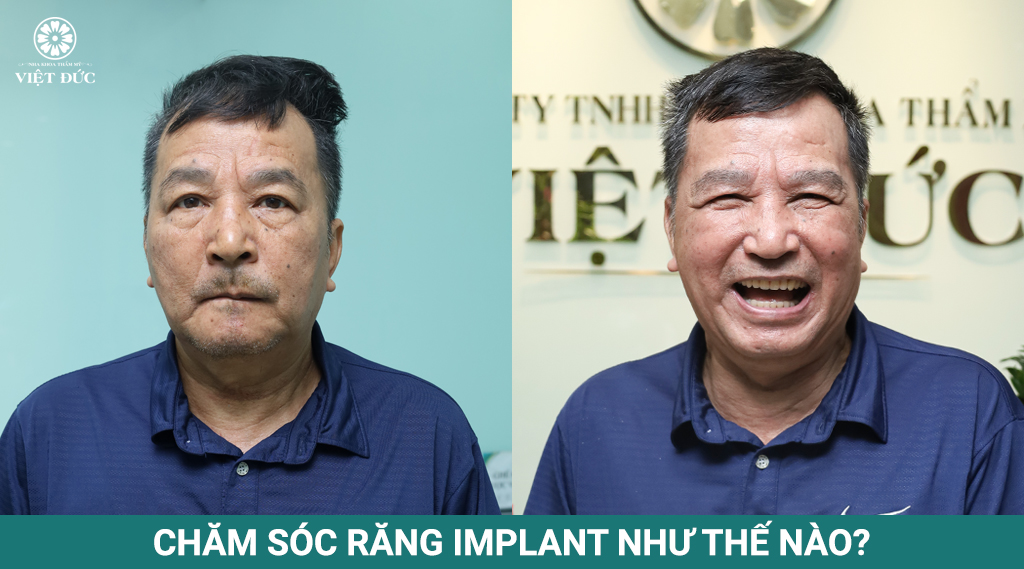 Chăm sóc răng implant
