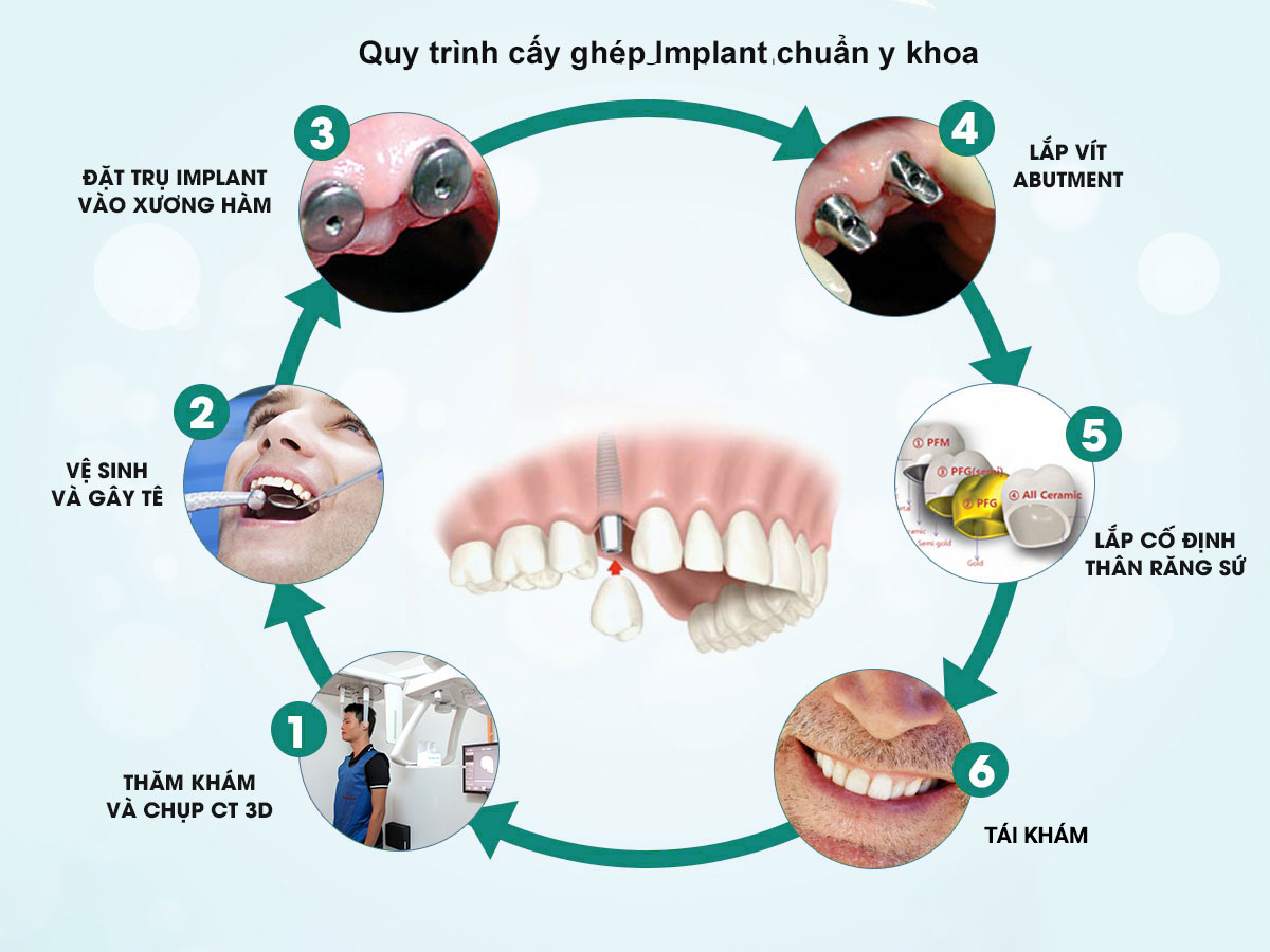 Quy trình cấy implant